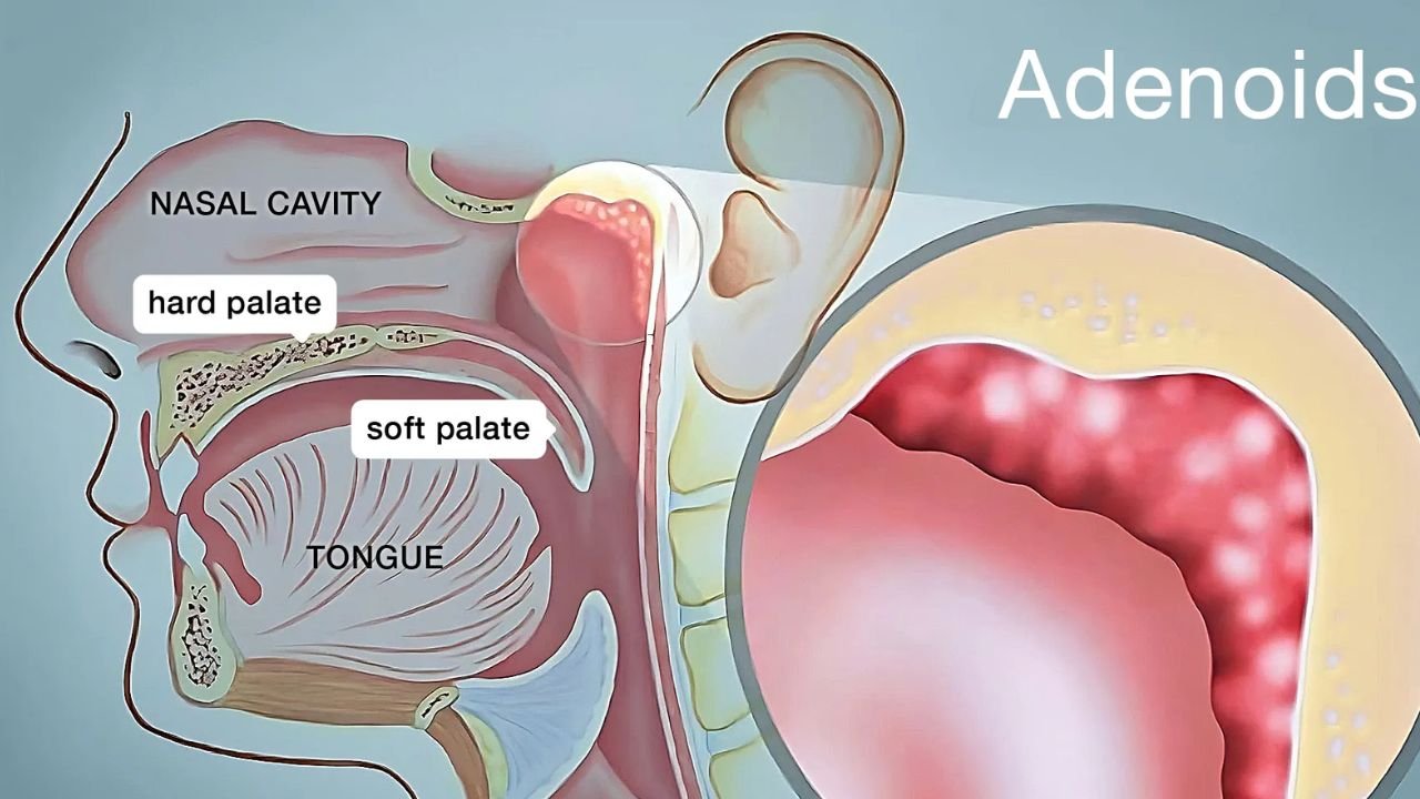 adenoidid